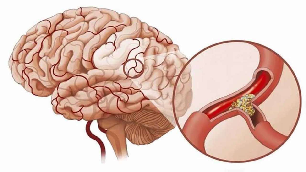 Причины сужения головного мозга. Атеросклеротическое поражение сосудов головного мозга. Атеросклероз сосудов ГМ. Церебральный атеросклероз сосудов головного мозга. Инсульт ишемический (закупорка сосуда).