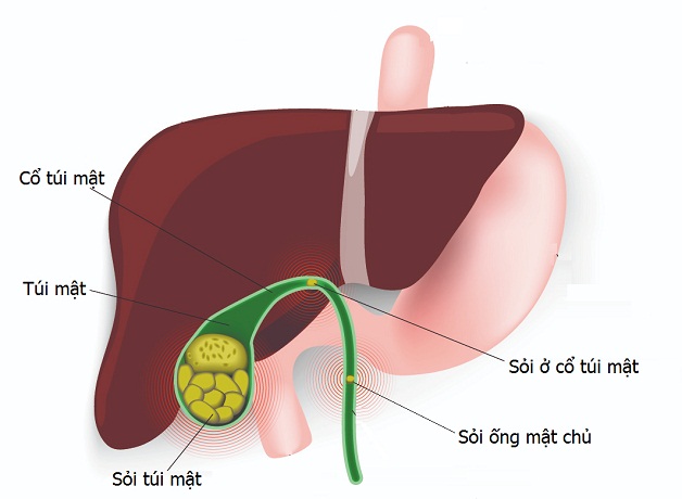 Nội soi lấy sỏi mật chỉ định trong trường hợp nào?