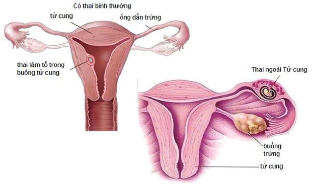 chửa ngoài tử cung vỡ