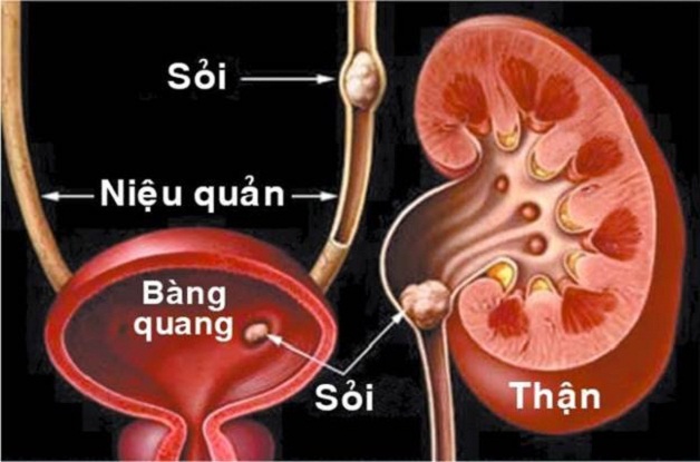 Sỏi xuống bàng quang gây nhiều biến chứng nguy hiểm