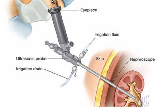 Tán sỏi tiết niệu qua da đường hầm nhỏ