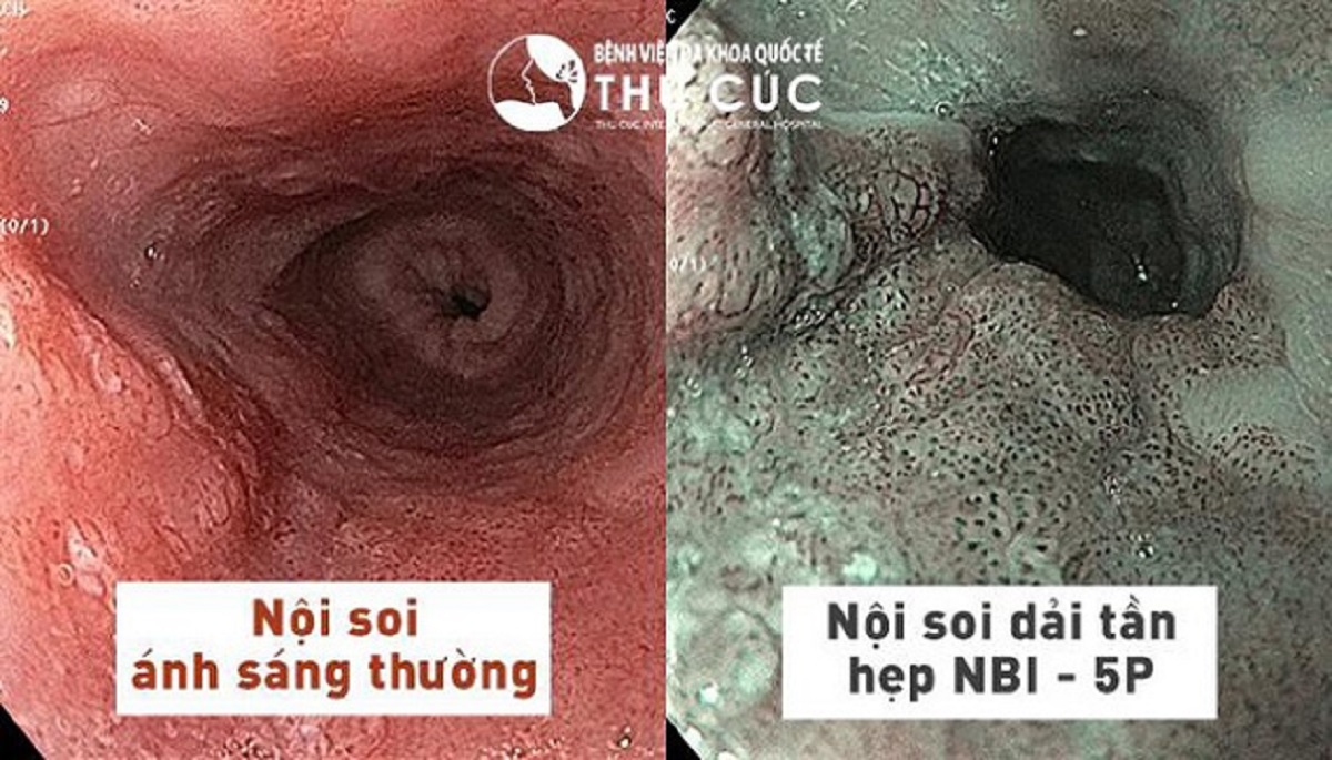 Nội Soi NBI Là Gì? Tìm Hiểu Công Nghệ Nội Soi Tiên Tiến