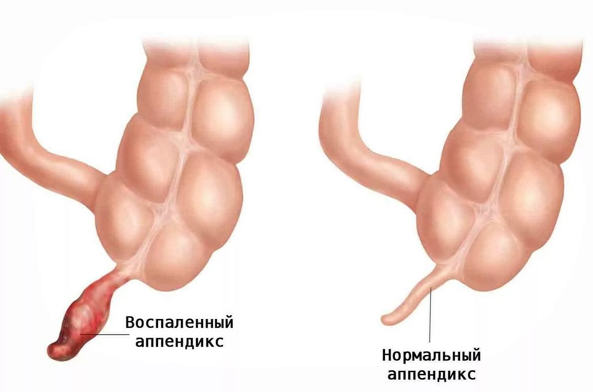 может ли быть температура после операции на аппендицит