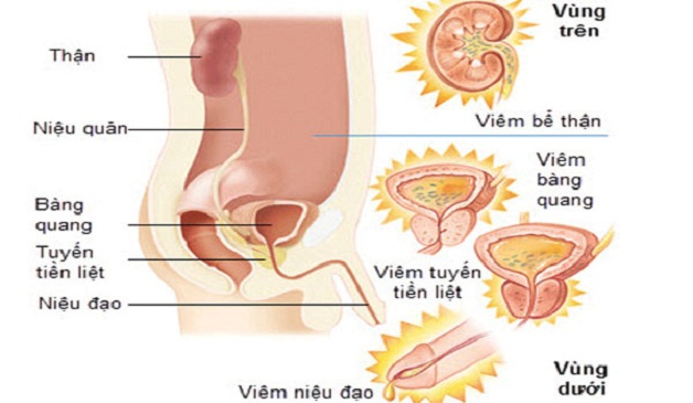 Viêm tiết niệu uống thuốc gì là thắc mắc của rất nhiều người bệnh.