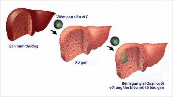 Viêm gan C có chữa được không là điều nhiều người lo lắng?