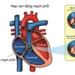 Các mức độ hẹp van động mạch phổi và cách điều trị