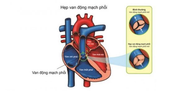 Hở van động mạch phổi 1/4 là như thế nào? | TCI Hospital
