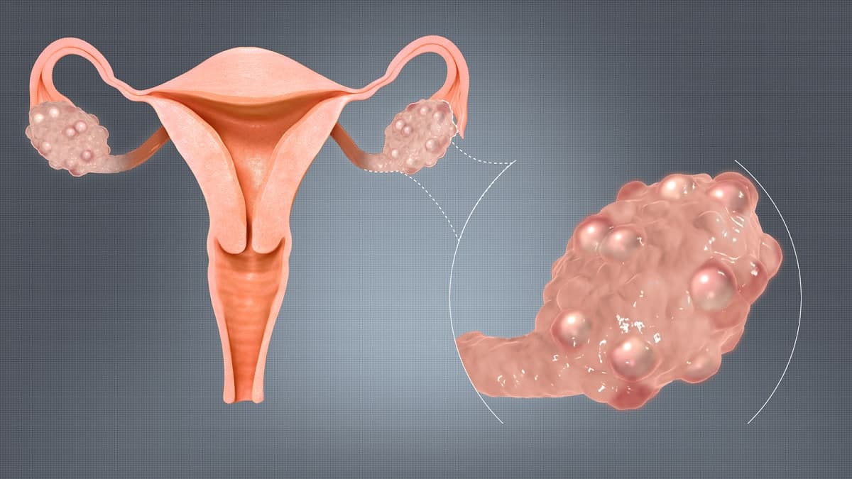 Phẫu thuật cắt buồng trứng: Phẫu thuật cắt buồng trứng là cách tốt nhất để điều trị ung thư buồng trứng hoặc ngăn ngừa thai ngoài tử cung. Hãy xem các hình ảnh minh họa chi tiết về quá trình phẫu thuật và các biện pháp hỗ trợ phục hồi sức khỏe nhanh chóng cho bản thân.