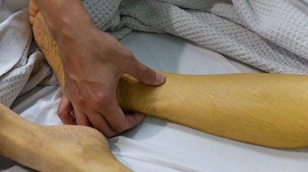 Viêm gan C ở giai đoạn nặng gây vàng da nhiều