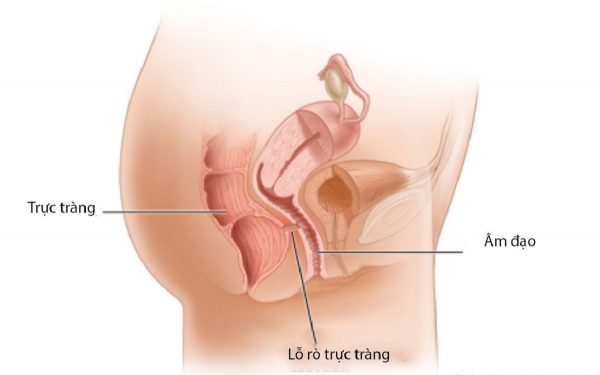 Hình ảnh minh họa vị trí lỗ rò âm đạo trực tràng