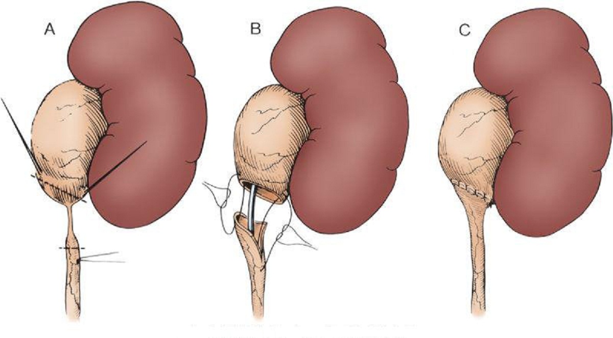 Có những hệ quả và tác động dài hạn mà bệnh giãn đài bể thận ở trẻ em có thể gây ra không?