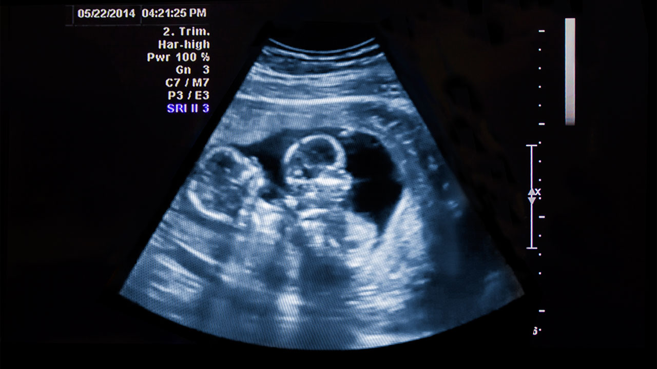 Hình ảnh siêu âm thai đôi 7 tuần như thế nào?