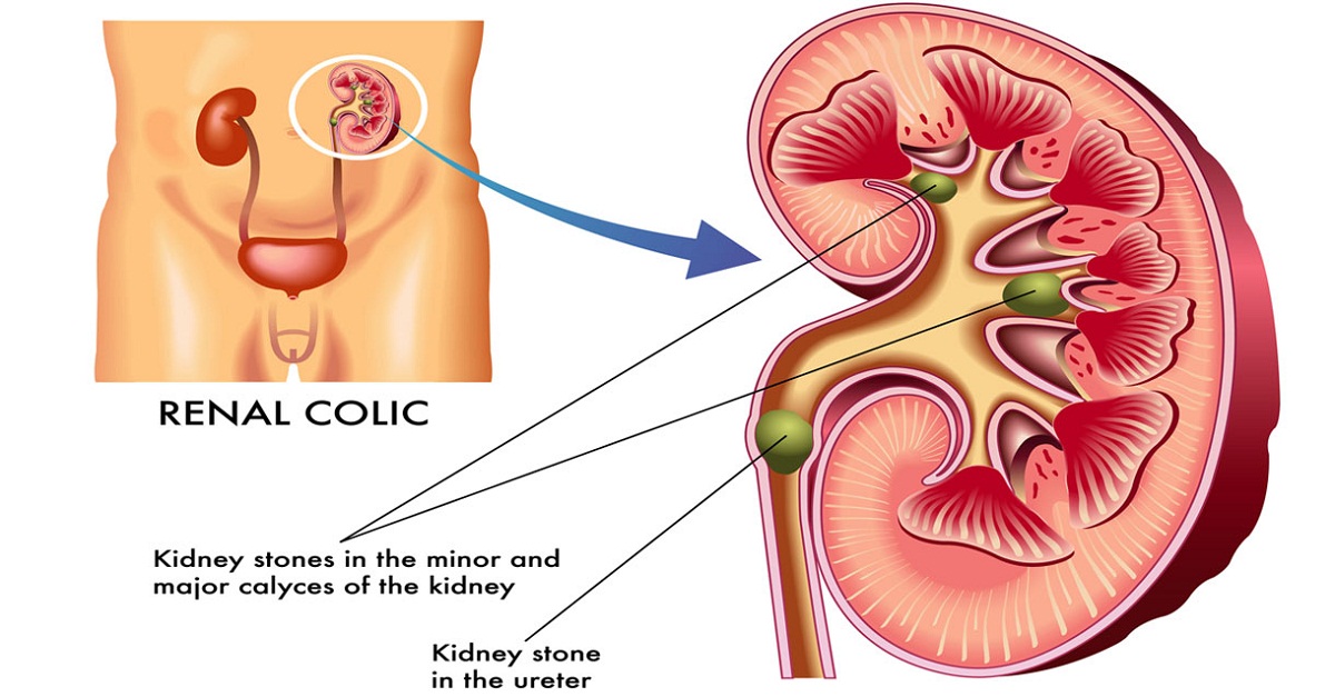 Sỏi thận có thể gây ra những vấn đề sức khỏe nào nếu không được điều trị kịp thời?
