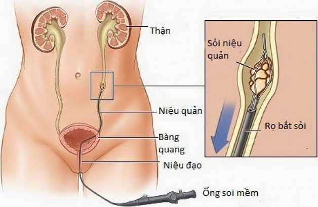 Tán sỏi laser bằng ống soi mềm lấy sỏi thận không gây tổn hại đến thận