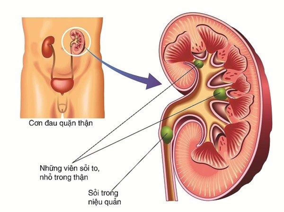 Có những biện pháp điều trị nào cho nang thận 25mm? Liệu có cần phẫu thuật không?
