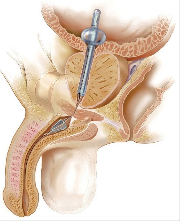 Tạo hình niệu đạo bằng bằng cách đặt stent niệu đạo là phương pháp xâm lấn tối thiểu, ít sang chấn và có hiệu quả cao
