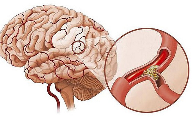 80% bệnh nhân thiếu máu não có nguyên nhân từ chứng xơ vữa động mạc
