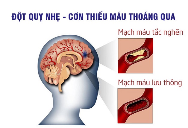 Cơn Thiếu Máu Não Cục Bộ Thoáng Qua (TIA)