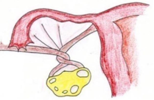 Khi các u nang bì phát triển, có thể khiến buồng trứng dịch chuyển, dẫn đến hiện tượng xoắn buồng trứng.