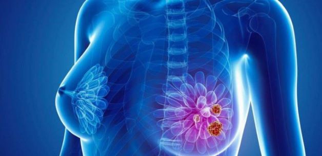 Khi các khối u nang phát triển, vẫn có khả năng tế bào ung thư hình thành bên trong các khối nang.