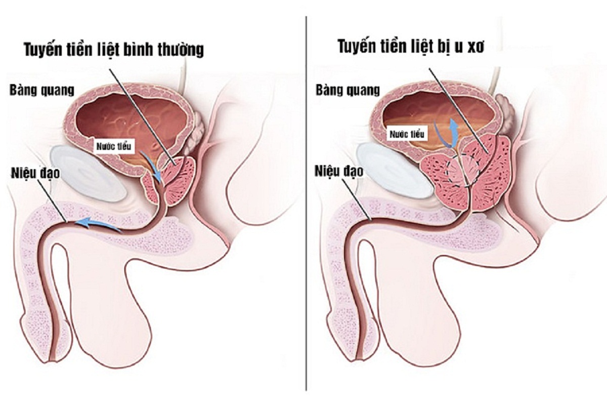 Thuốc điều trị phì đại tiền liệt tuyến hiệu quả nhất hiện nay là gì?
