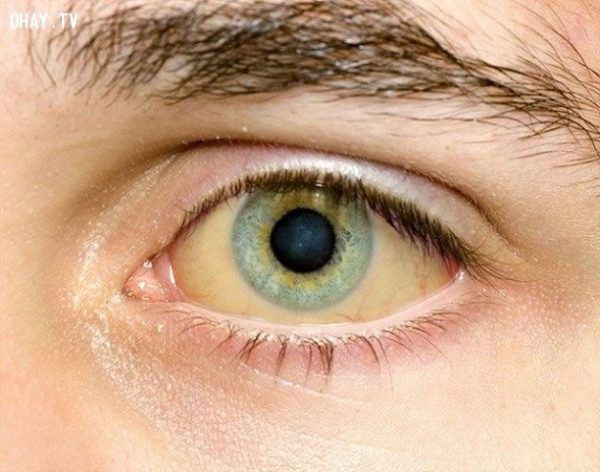 Vàng mắt là dấu hiệu thường gặp của bệnh viêm gan A