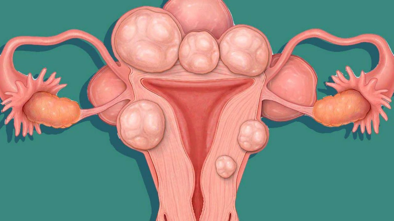 What are the potential complications of having a 20mm fibroid in the uterus during pregnancy?