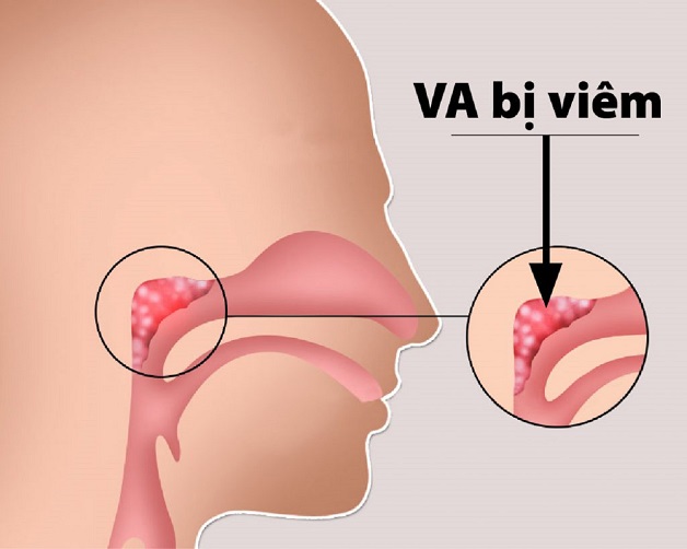 "Viêm VA là gì?" - VA là tổ chức lympho vùng hòm họng chứa các tế bào bạch hầu. Viêm VA là tình trạng quá phát của tổ chức lympho này
