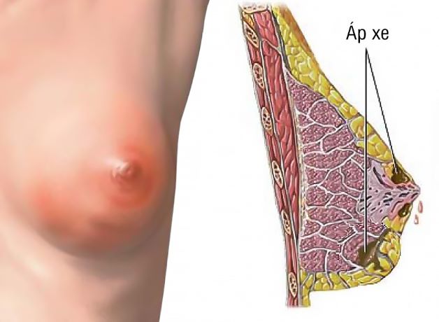 Áp xe vú do vi khuẩn gây ra, khiến tích tụ mủ trong vú.