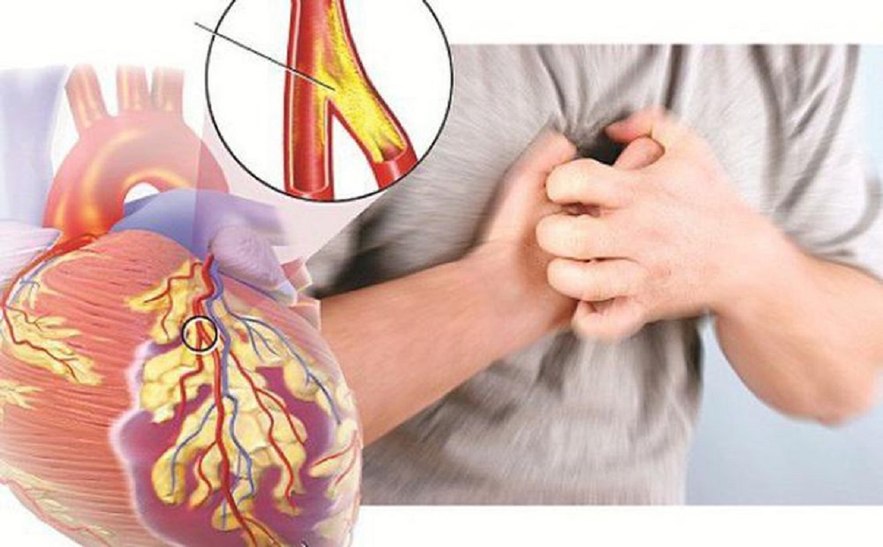 Chữa trị bệnh mạch vành mạn hiệu quả với phương pháp tự nhiên
