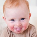Tình trạng trẻ bị nổi mẩn đỏ xung quanh miệng là bệnh gì? 