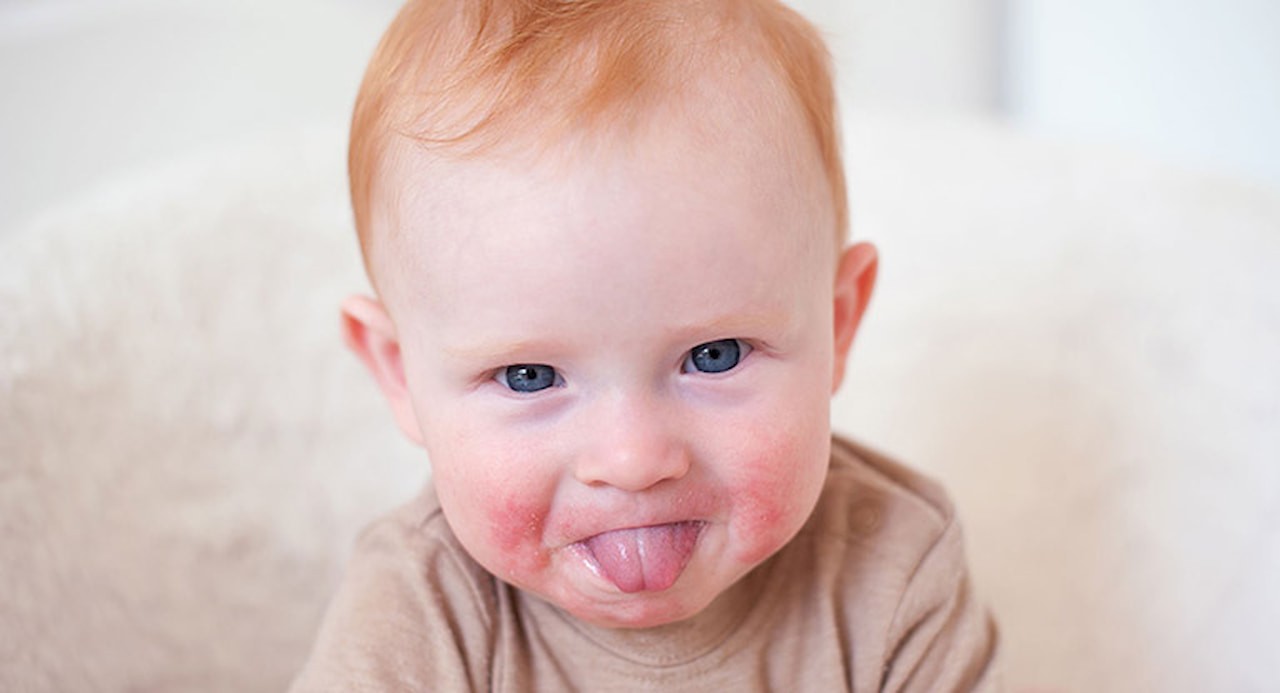 Những nguyên nhân gây trẻ bị mọc mụn nhỏ quanh miệng và cách phòng tránh