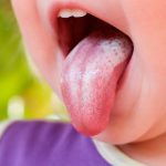 Mách mẹ phương pháp phòng tránh hiệu quả bệnh nấm miệng ở trẻ em