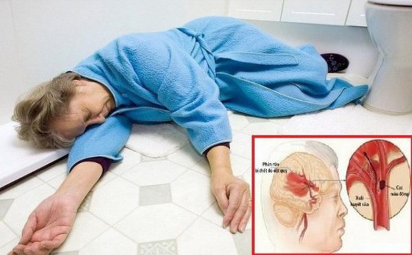 bệnh thiếu máu não nguy hiểm không