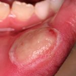 Bệnh viêm niêm mạc miệng có thể điều trị hiệu quả bằng cách nào?
