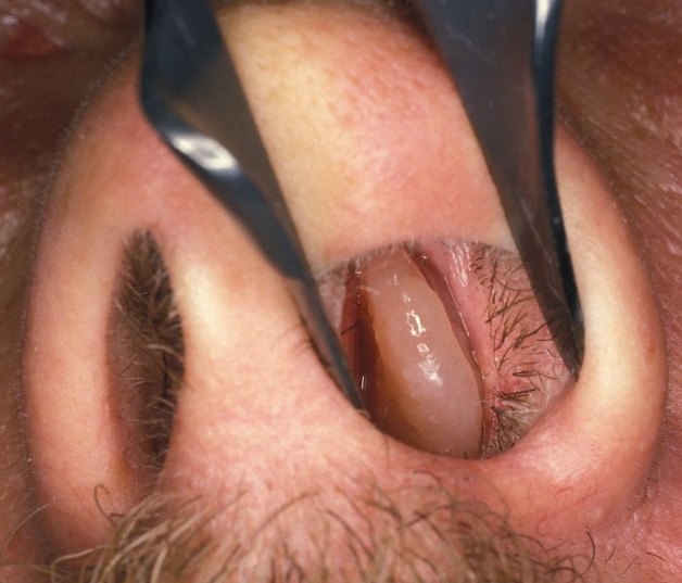 Giải đáp cắt polyp mũi có nguy hiểm không? | TCI Hospital