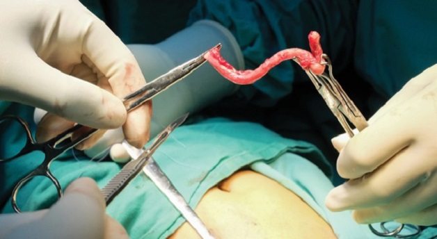 Phẫu thuật nội soi cắt ruột thừa