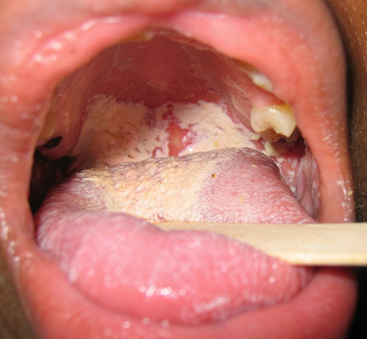 Từ hình ảnh nấm miệng, nhận biết triệu chứng để điều trị