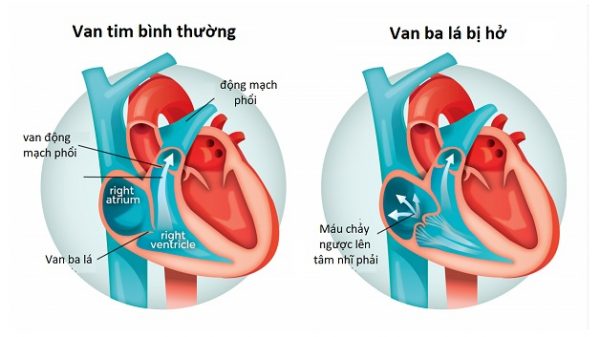 Hở van tim ¼ là mức độ nhẹ nhất của hở van tim