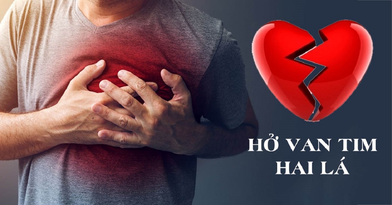 Tìm hiểu về hở van tim 2 lá 1/4 là gì Nguyên nhân, triệu chứng, và cách điều trị