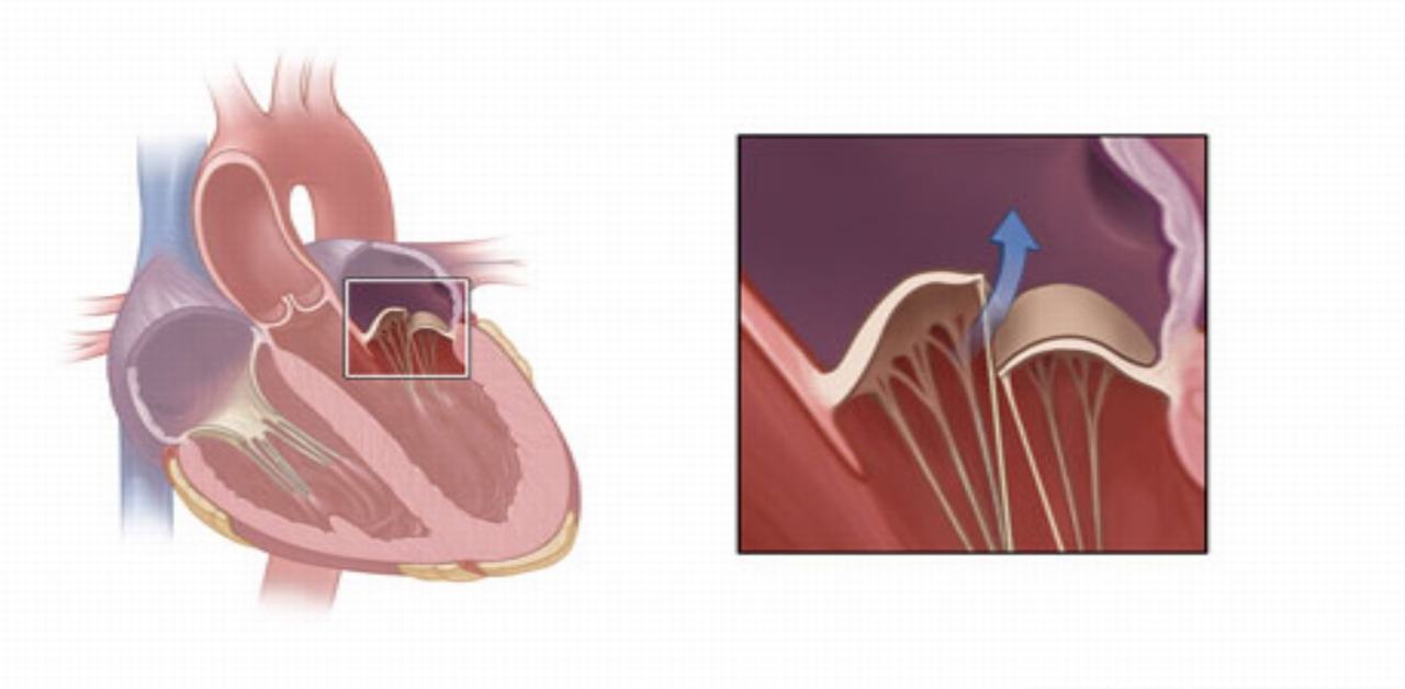 Các biến chứng có thể xảy ra do hở van tim 2/4?
