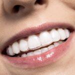 5 điều không thể bỏ qua về nắn chỉnh răng bằng invisalign