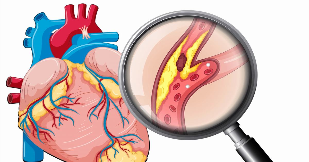 Tìm hiểu nguyên nhân bệnh mạch vành và cách phòng ngừa hiệu quả