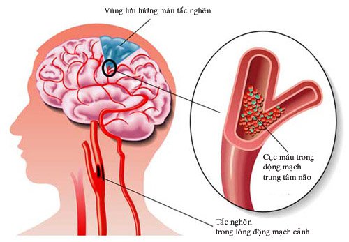 nguyên nhân đau nửa đầu trên