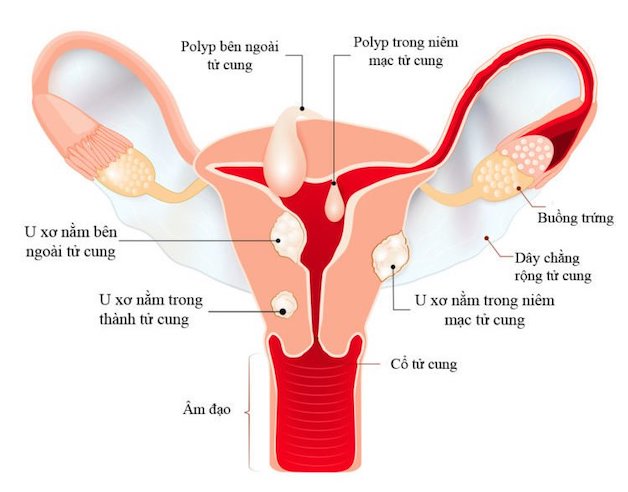 Chữa nhân xơ tử cung nhỏ: Các phương pháp hiệu quả và an toàn