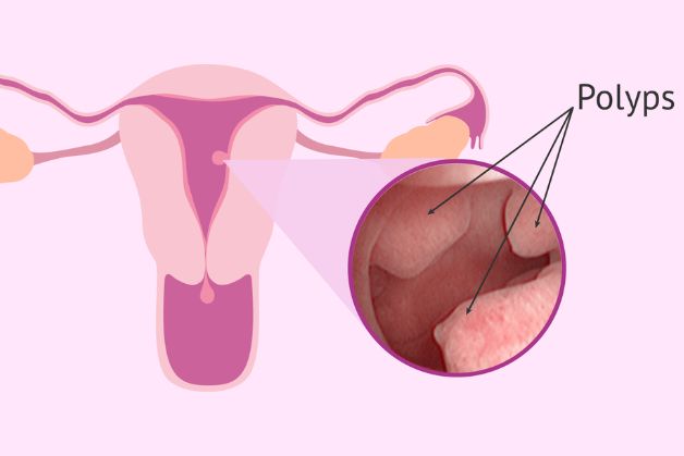 4. Phẫu Thuật Polyp Tử Cung