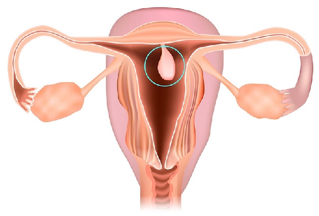 Polyp cổ tử cung là một vấn đề phổ biến mà nhiều phụ nữ phải đối mặt.