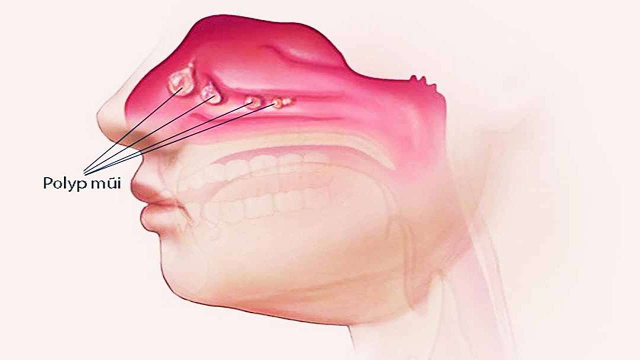 Viêm mũi xoang mạn tính có polyp có thể tái phát sau điều trị không?