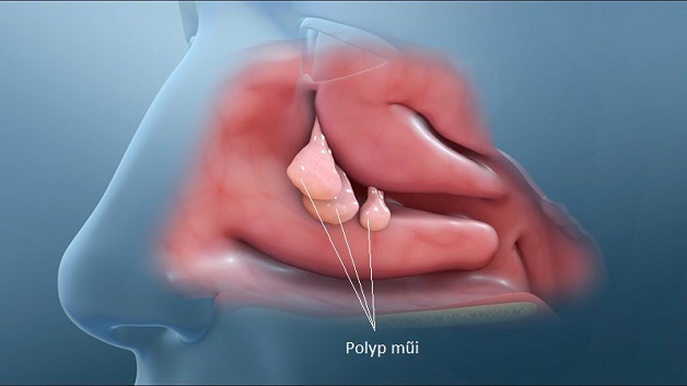 Polyp mũi là bệnh gì là thắc mắc của nhiều người đang mắc các bệnh liên quan đến tai mũi họng.