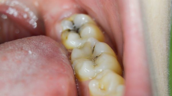 Bị buốt răng hàm thì phải điều trị như thế nào? | TCI Hospital